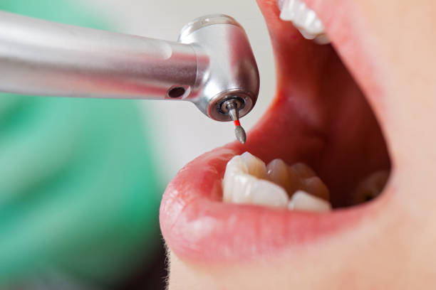 Best Broken or Chipped Tooth Repair in West Bay Shore, NY